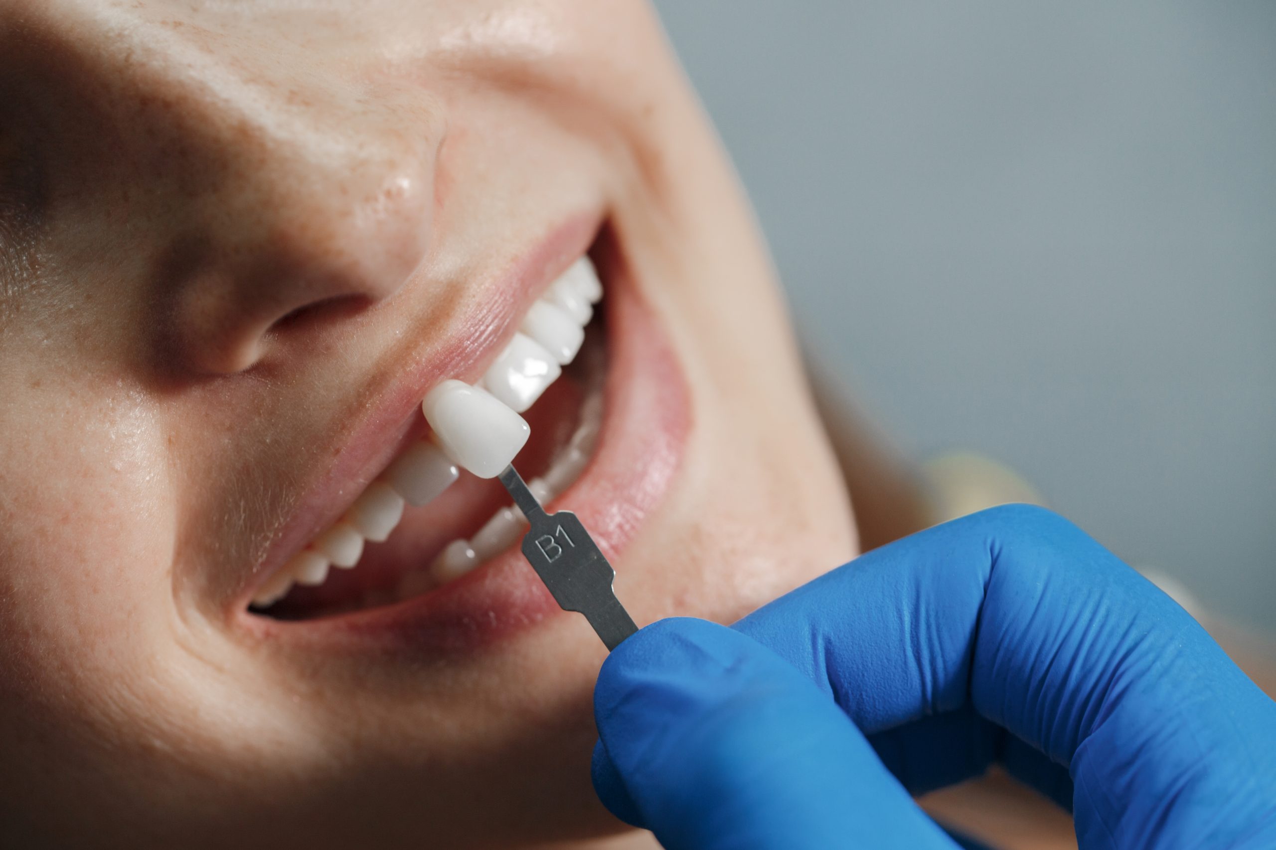 Zahnarzt mit Zahnmodell zur Planung von Veneers